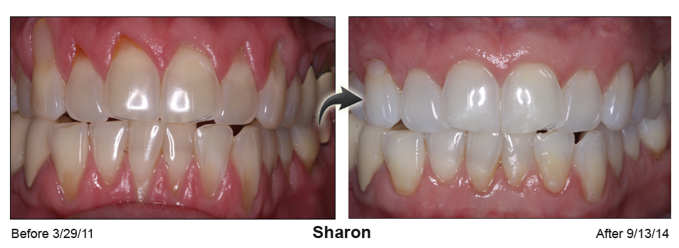 Before and Afte picture